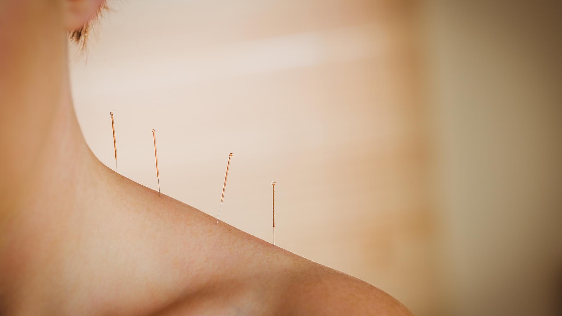 What Are The Benefits of Acupuncture