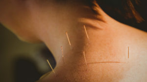 Fertility Acupuncture