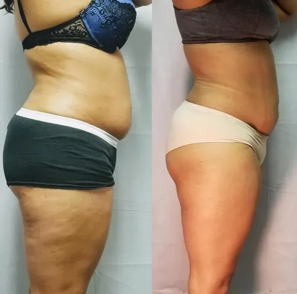 Lipo Laser Before & After 1