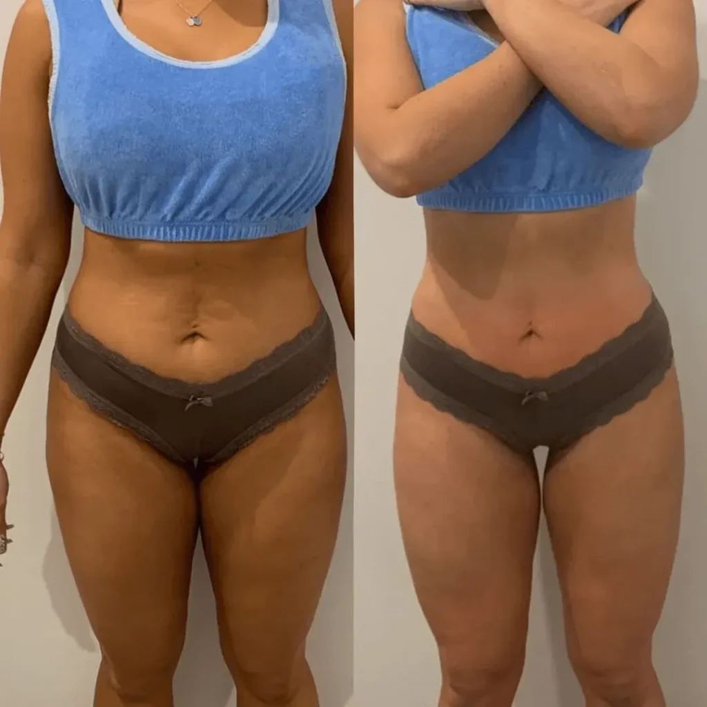 Lipo Laser Before & After 2