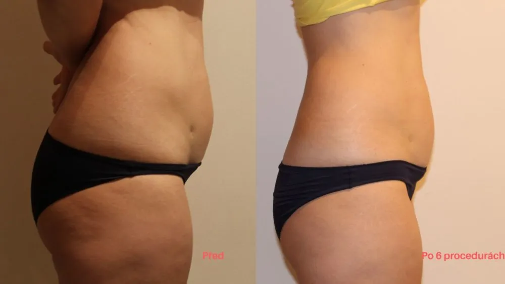 Lipo Laser Before & After 3