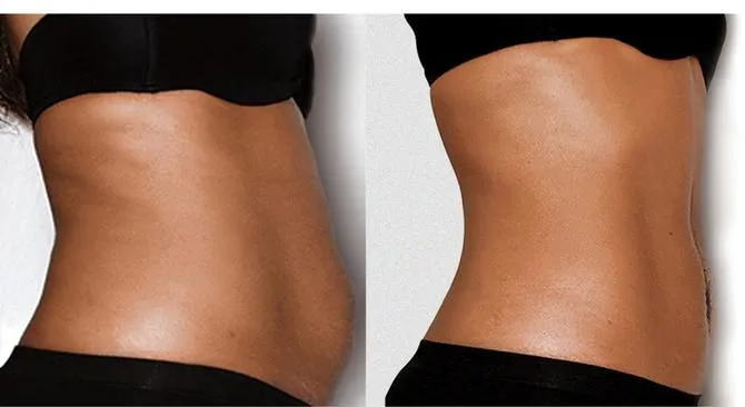 Lipo Laser Before & After 4