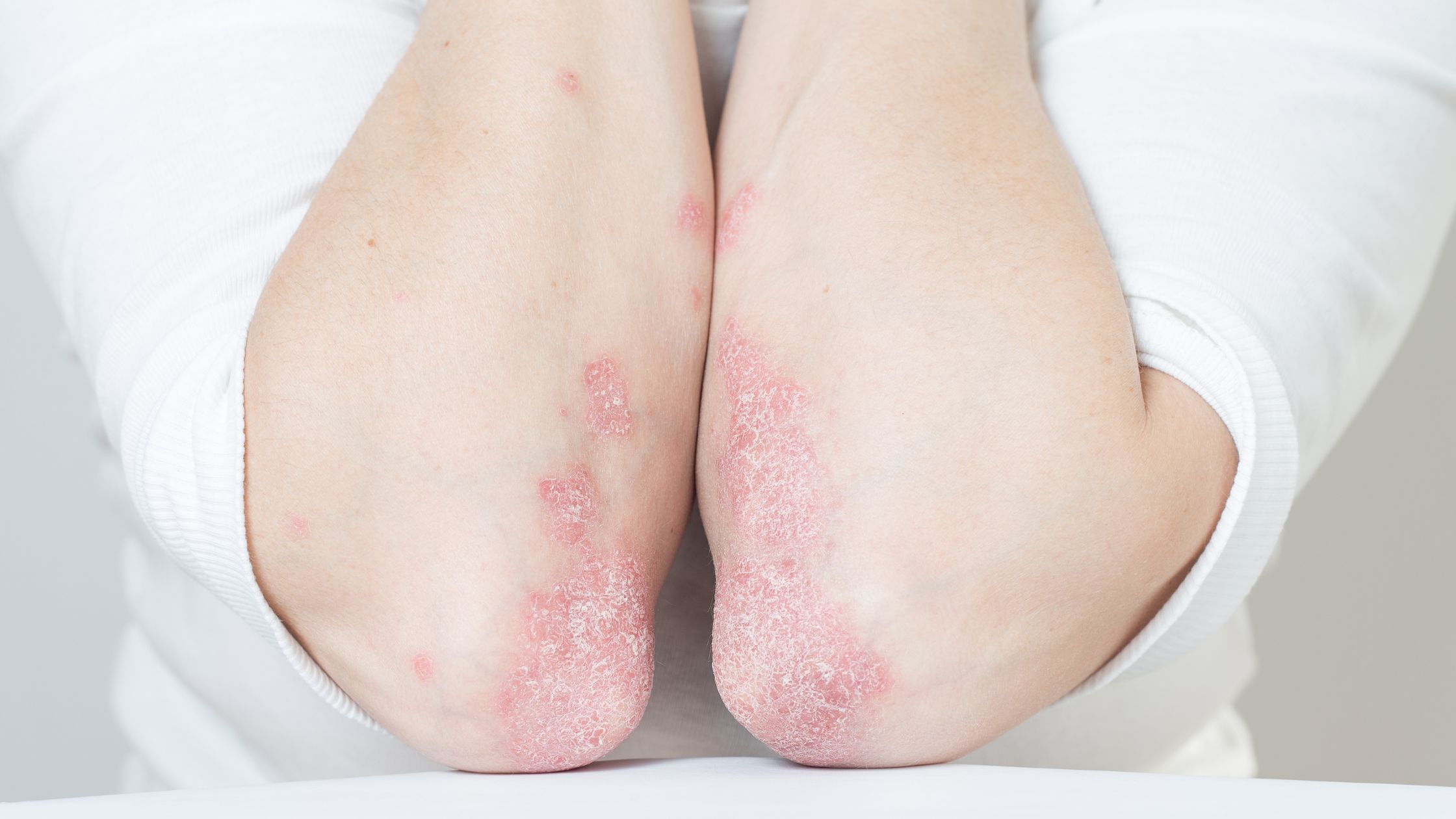 Early Warning Signs of Psoriatic Arthritis