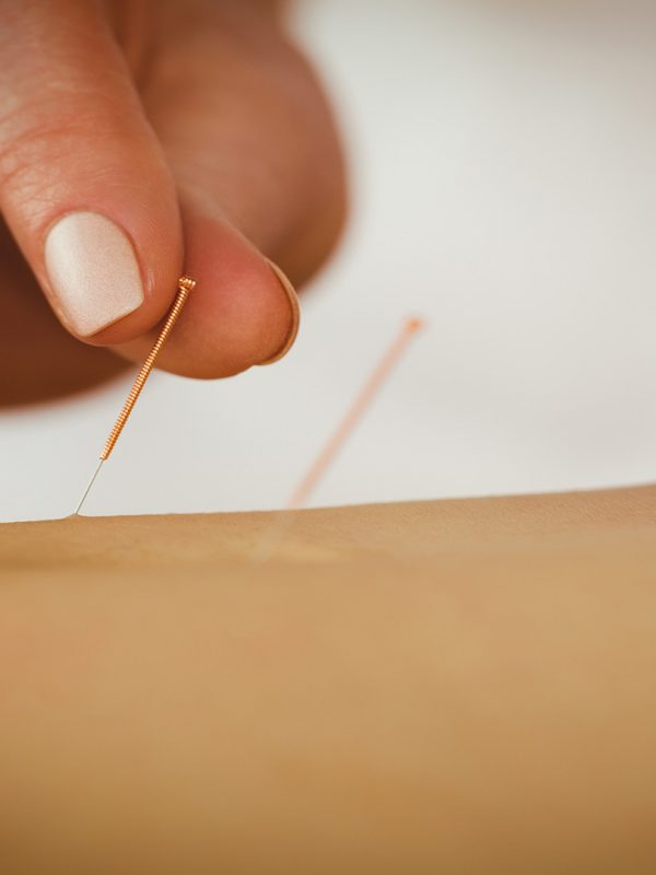 Young woman getting acupuncture treatment in therapy room